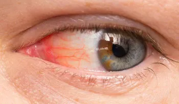 Remedios caseros para las infecciones en los ojos