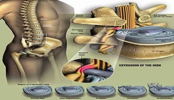 ¿Cómo curar la hernia de disco, sin una cirugía?