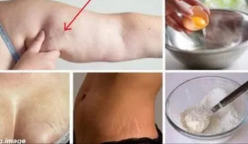 Las mujeres están locas con este remedio que elimina la flacidez, celulitis y estrías