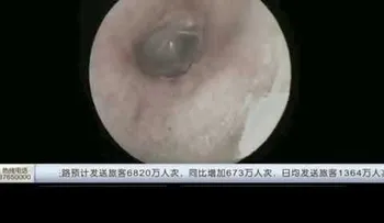 IMAGENES PODRIAN SER SENSIBLES: Una araña tejía su tela dentro del oído de un hombre