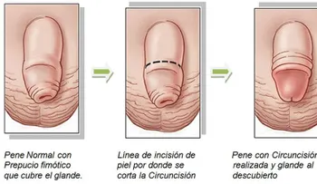 Los beneficios de la circuncisión