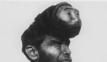 La increíble historia del mexicano de dos cabezas