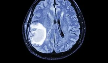 Descubren forma para atacar metástasis cerebrales