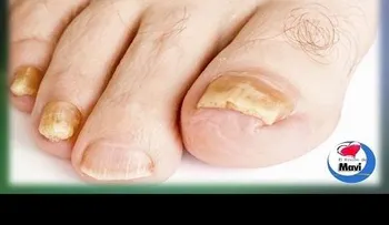 Un tratamiento efizca para curar los hongos en las uñas de los pies y manos 