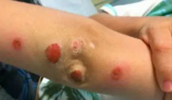 Notó que su hijo llegó de una fiesta con estas marcas en su brazo; no creerás lo que dijo el doctor
