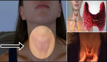Ya basta de medicamentos y doctores mintiendo, la cura para la tiroides la tiene usted en su casa, después que descubra el ingrediente para curarla, dirá wao porque no leâ?¦