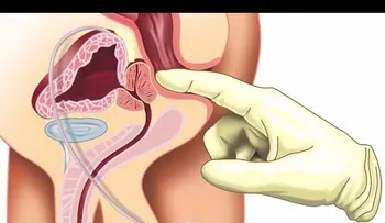 ¿Qué es la prostatitis? (VIDEO)