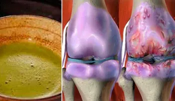 Esta fórmula tiene locos a todo el mundo!! cura tus rodillas, restituye tus huesos y tus articulaciones en seguida.