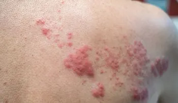 El estrés puede activar la culebrilla o herpes zóster y afectar seriamente la vista
