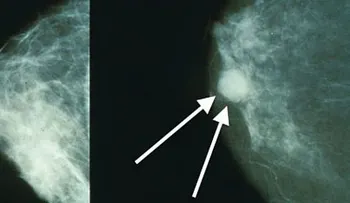 Si tiene cáncer o conoce a quien que lo tiene...lee esto de inmediato y compartelo