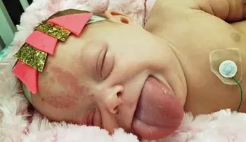 Una bebé con lengua del tamaño de un adulto ahora puede respirar y sonreír con normalidad 