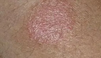 Cómo tratar el eczema con pasta de nuez moscada  