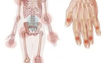 Inflamación causada por la psoriasis puede afectar las articulaciones