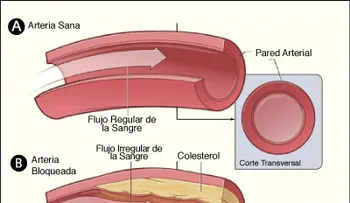 La importancia de bajar el colesterol