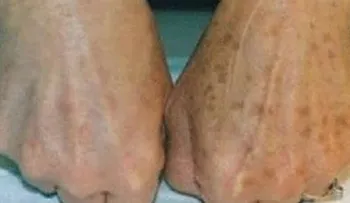 Tiembla la industria de los cosméticos con esta crema casera para quitar las manchas!