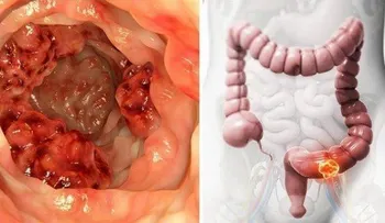 Científicos comprueban que este aceite destruye el 90% células del cáncer de colon en 3 días...
