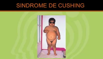 No confunda obesidad con enfermedad de Cushing