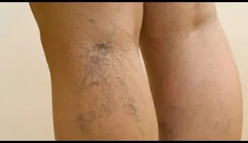 Remedios Imperdibles para eliminar las varices 