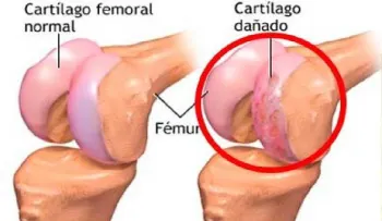 Mi esposo regeneró sus cartilagos dañados con estos 3 alimentos (VIDEO