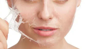 ¿Qué es el peeling químico?
