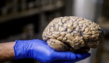  Líquido de tejido cerebral muerto después de un ataque es tóxico y dañino 