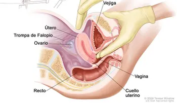Tratamiento tumores de ovario de bajo potencial maligno