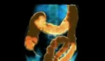 Una limpieza intestinal 100% comprobada 