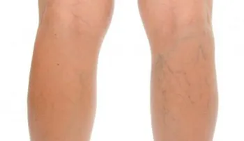 Consejos para prevenir las várices 