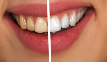 Efectiva alternativa casera para blanquear los dientes