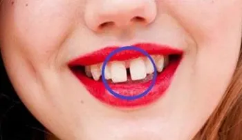 Si tienes o conoce a alguien con dientes separados, tiene que leer esto URGENTEMENTE!!