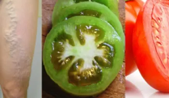 Increíble! Con un tomate puede curar las venas varicosas