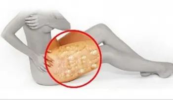 Técnica para terminar con la Celulitis con la ayuda de Vinagre de Manzana.