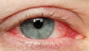 Tips naturales para tratar los ojos irritados