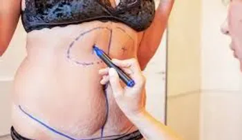 Liposucción: Riesgos y complicaciones
