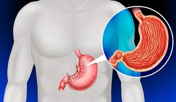 Carne procesada podría incrementar el riesgo de cáncer en el estómago