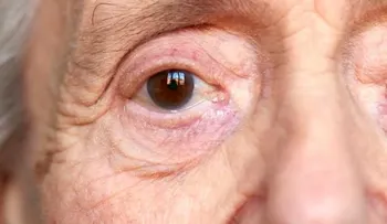 Relacionan el alzhéimer con tres enfermedades de los ojos