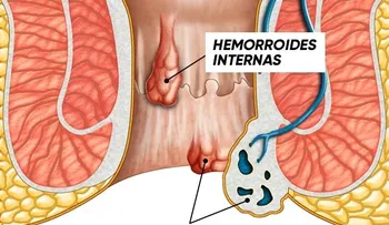 Pomada e infusiones para las hemorroides