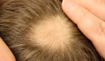 Terminar con la alopecia areata naturalmente