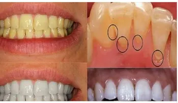 Aplica vinagre de manzana en tus dientes.¡Esto es lo que sucederá! 
