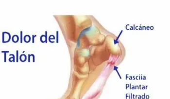 Dolor en los talones y su tratamiento natural