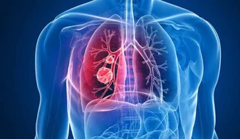 El 90 % de pacientes con cáncer de pulmón mueren debido a la detección tardía