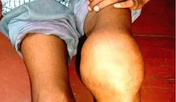 Daños articulares y hemorragias severas son padecidos por pacientes con hemofilia