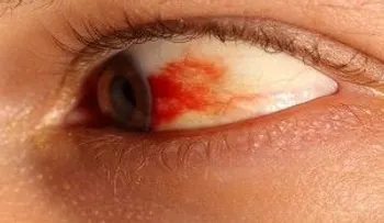 3 Ingredientes que curan las arterias obstruidas, grasa y las infecciones