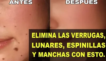 Esta sencilla receta casera elimina verrugas, lunares, espinillas y manchas de tu cuerpo 