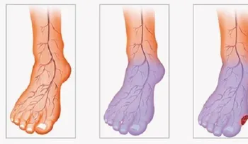 ¿Problemas de circulación de la sangre, frío en las piernas y las manos? esto es lo que debes hacer para controlarlo