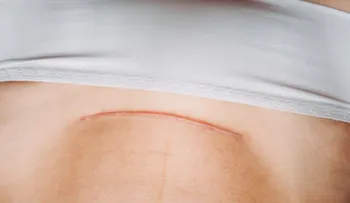 Una mujer se realizó su propia cesárea y sobrevivió