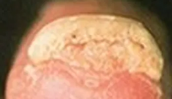 Enfermedades, Patologías y Problemas de las uñas