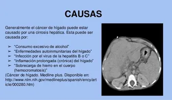 Advierten cáncer que produce consumo de alcohol 