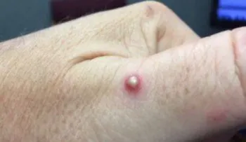 Cómo identificar las 8 picaduras más comunes que existen