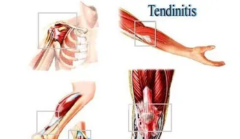 La tendinitis; causas y tratamientos